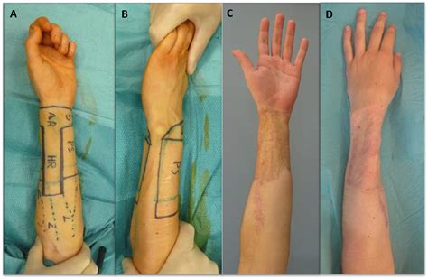 phalloplasty results 2018|Outcomes after Phalloplasty: Do Transgender Patients and.